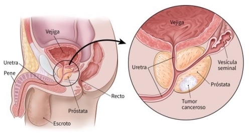 El cáncer de próstata