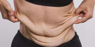 ¿Un abdomen flácido puede causar dolor de espalda?
