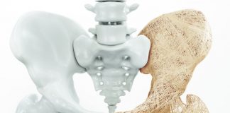 La osteoporosis