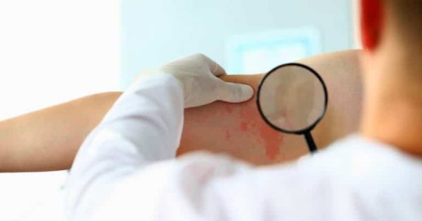Cuidados de tu piel ¿Qué es la dermatitis atópica y cómo atenderla?