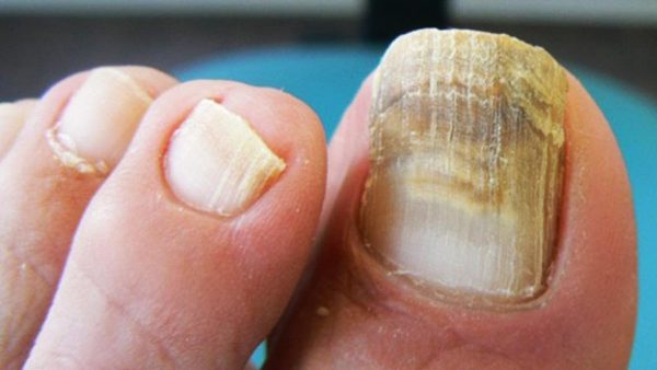 hongos en los pies