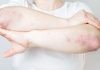 la psoriasis