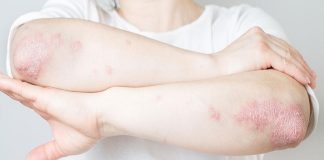Los mejores trucos para combatir la psoriasis la psoriasis