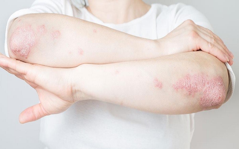 psoriasis la psoriasis