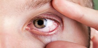 La alergia ocular del ojo seco