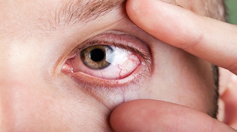 La alergia ocular del ojo seco