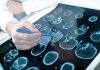 Con una quimioterapia logran hacer que penetre en el cerebro contra un tumor mortal quimioterapia