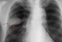 Identifican nuevos biomarcadores del cáncer de pulmón Nuevos biomarcadores del cáncer de pulmón