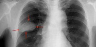 Nuevos biomarcadores del cáncer de pulmón