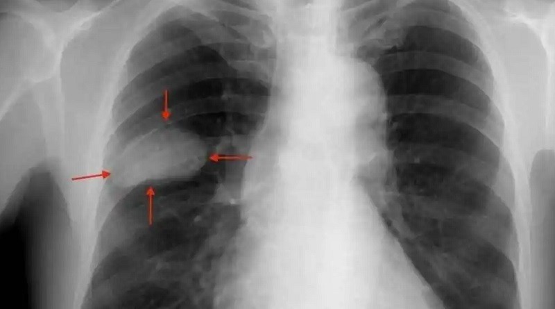 cáncer Nuevos biomarcadores del cáncer de pulmón
