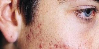Nuevo método contra el acné