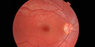 La degeneración macular