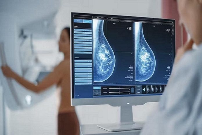 Cáncer de mama