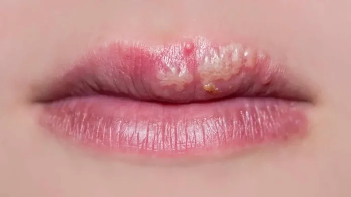 close-up-of-a-womans-lips-with-cold-sores-16X9-1024x576 El Herpes labial