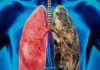 Cáncer de pulmón