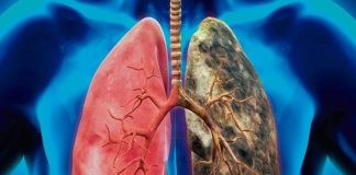 Cáncer de pulmón