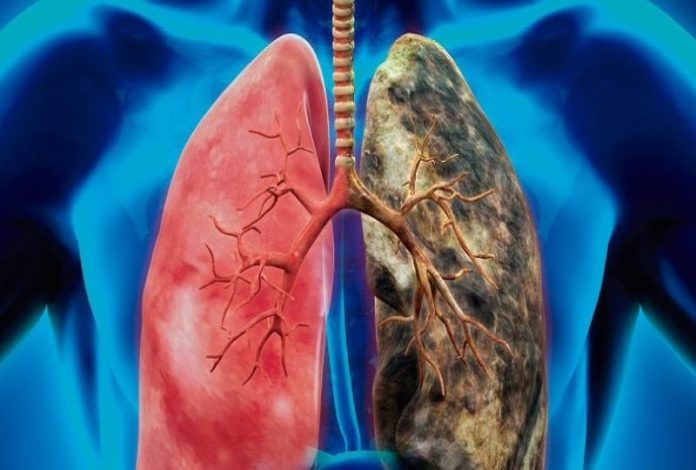 pulmon Cáncer de pulmón