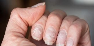 Cambios irregulares en las uñas pueden anunciar enfermedades las uñas