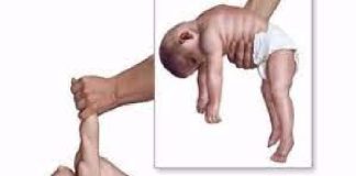 Día internacional de la enfermerdad de pompe