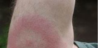 La Enfermedad de Lyme