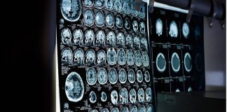 Escaneo cerebral