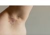 Día Mundial de la «Hidradenitis Supurativa» Día Mundial de la hidradenitis supurativa