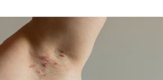 Día Mundial de la hidradenitis supurativa
