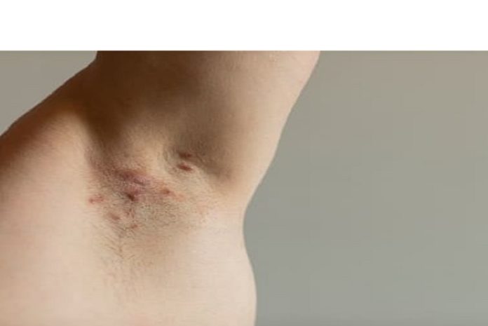 Día Mundial de la hidradenitis supurativa