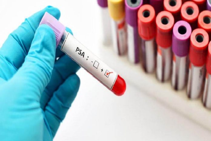 tubos El Cáncer de Próstata