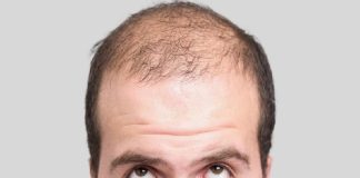 La calvicie en hombres