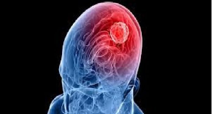 mdboyer El glioblastoma