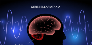 Hoy 25 de septiembre se celebra el Día Internacional de la Ataxia El Día Internacional de la Ataxia