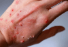 La OMS clasificada de alto riesgo la nueva variante de la mpox (viruela símica) Nueva variante de la mpox