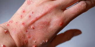 Nueva variante de la mpox