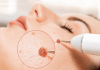melanoma