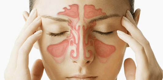 La sinusitis
