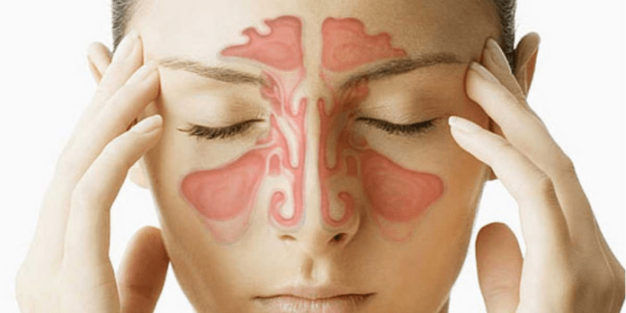 imagen_2025-02-07_112036006 La sinusitis