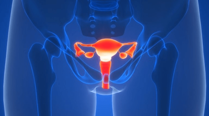 El cáncer de ovario