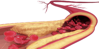 Molécula producida por la microbiota intestinal puede inducir a la aterosclerosis