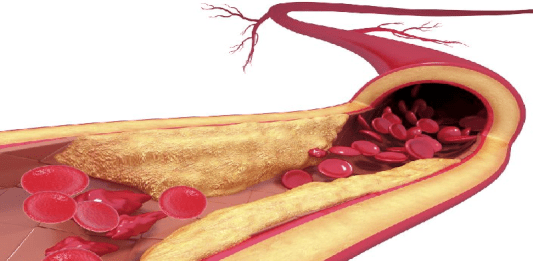 Molécula producida por la microbiota intestinal puede inducir a la aterosclerosis