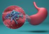 El cáncer de estómago