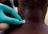 África: 4.275 muertes por cólera y mpox se registran en 2025 Muertes por cólera y mpox