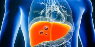 Casos de cáncer de hígado pueden evitarse