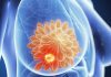 La metástasis del cáncer de mama
