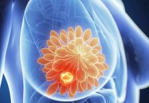 La metástasis del cáncer de mama