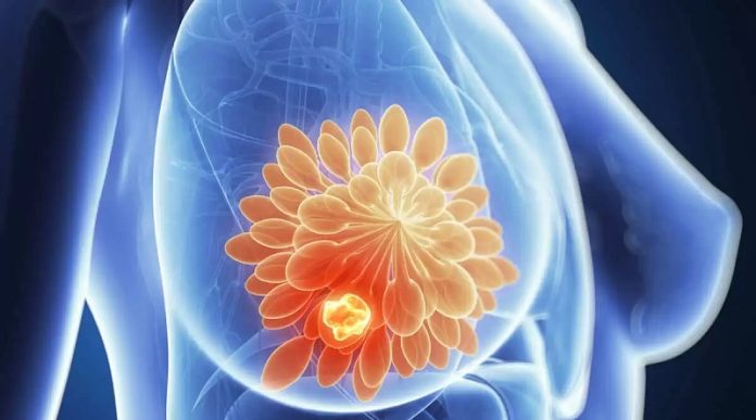 mama La metástasis del cáncer de mama