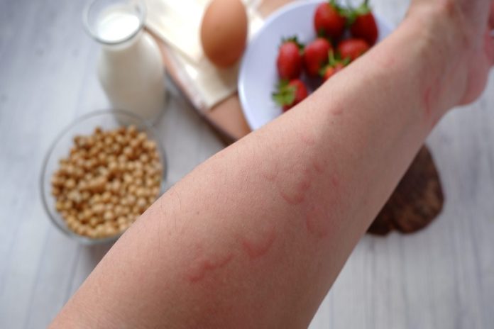 Las alergias alimentarias