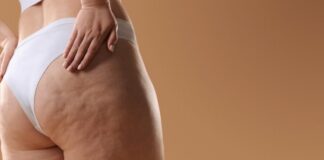 La celulitis