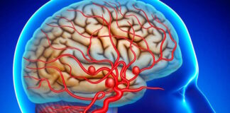 aneurisma cerebral