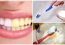 formas-blanquear-dientes